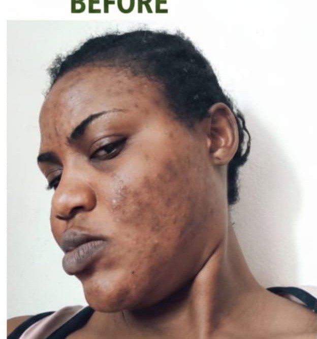 Before using Evalneth Revolution — skin with dark spots